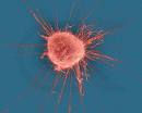 Pneumonia