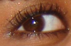 Eye Surgery